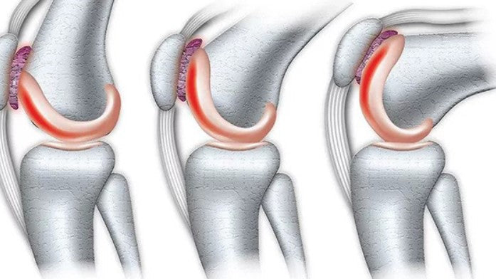 Patella Chondromalacia